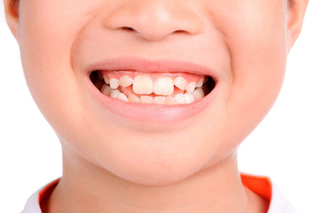 manchas-decoloracion-dientes-ninos