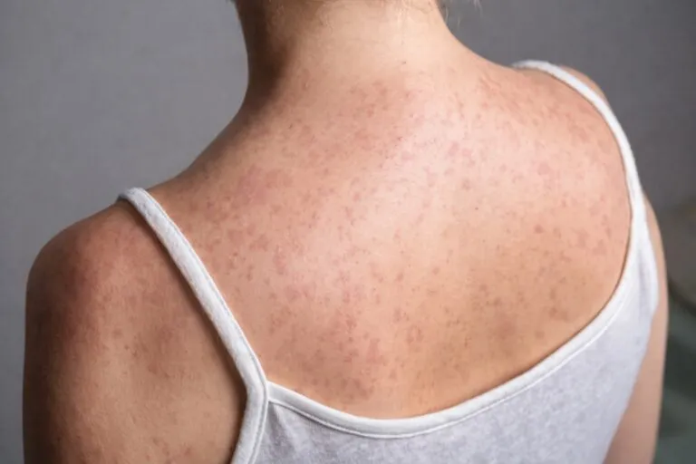 Imagen fotorrealista profesional de una persona con sarpullido causado por sarampión en la espalda, usada en medios educativos digitales