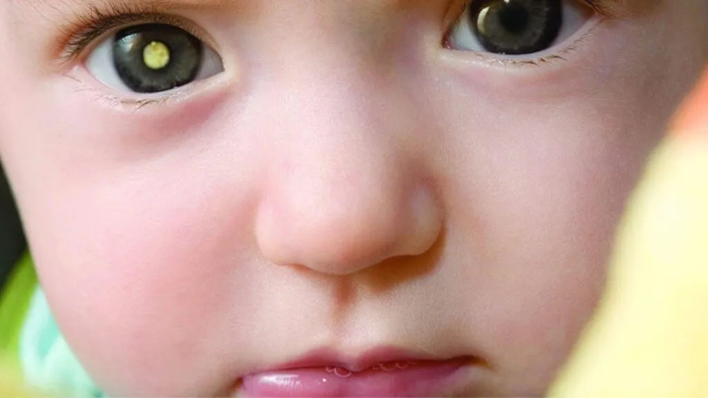 Especialista revisa a un paciente infantil para detectar retinoblastoma y preservar la visión mediante diagnóstico temprano