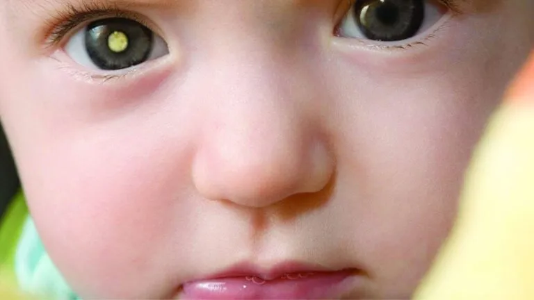 Especialista revisa a un paciente infantil para detectar retinoblastoma y preservar la visión mediante diagnóstico temprano