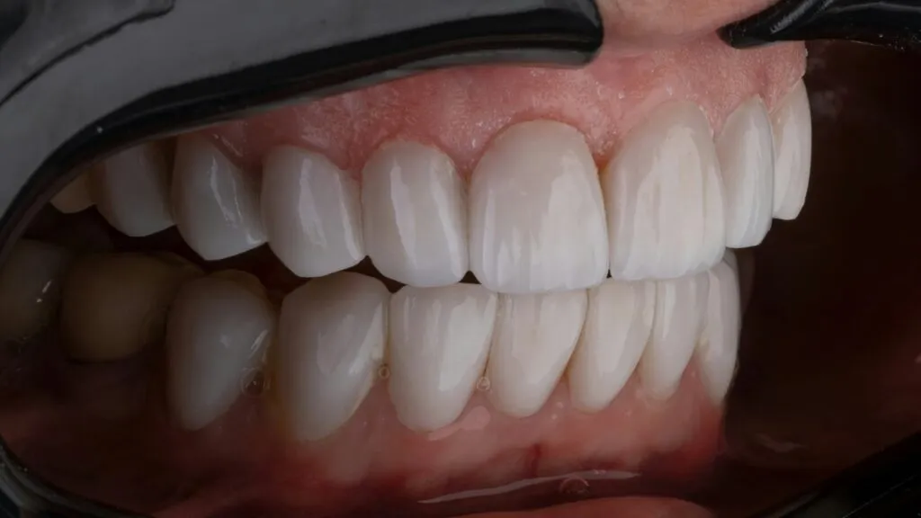 Uso responsable de antibióticos en tratamientos odontológicos para prevenir resistencia bacteriana.