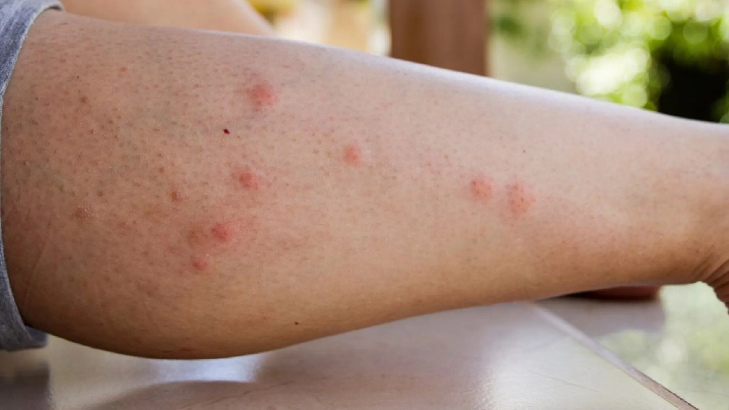 Los mosquitos utilizan dióxido de carbono, calor corporal, microbiota y señales químicas para identificar a las personas más atractivas.