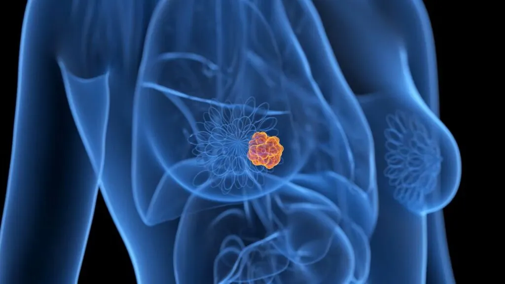 Cáncer de mama analizado mediante inteligencia artificial para predecir tratamientos
