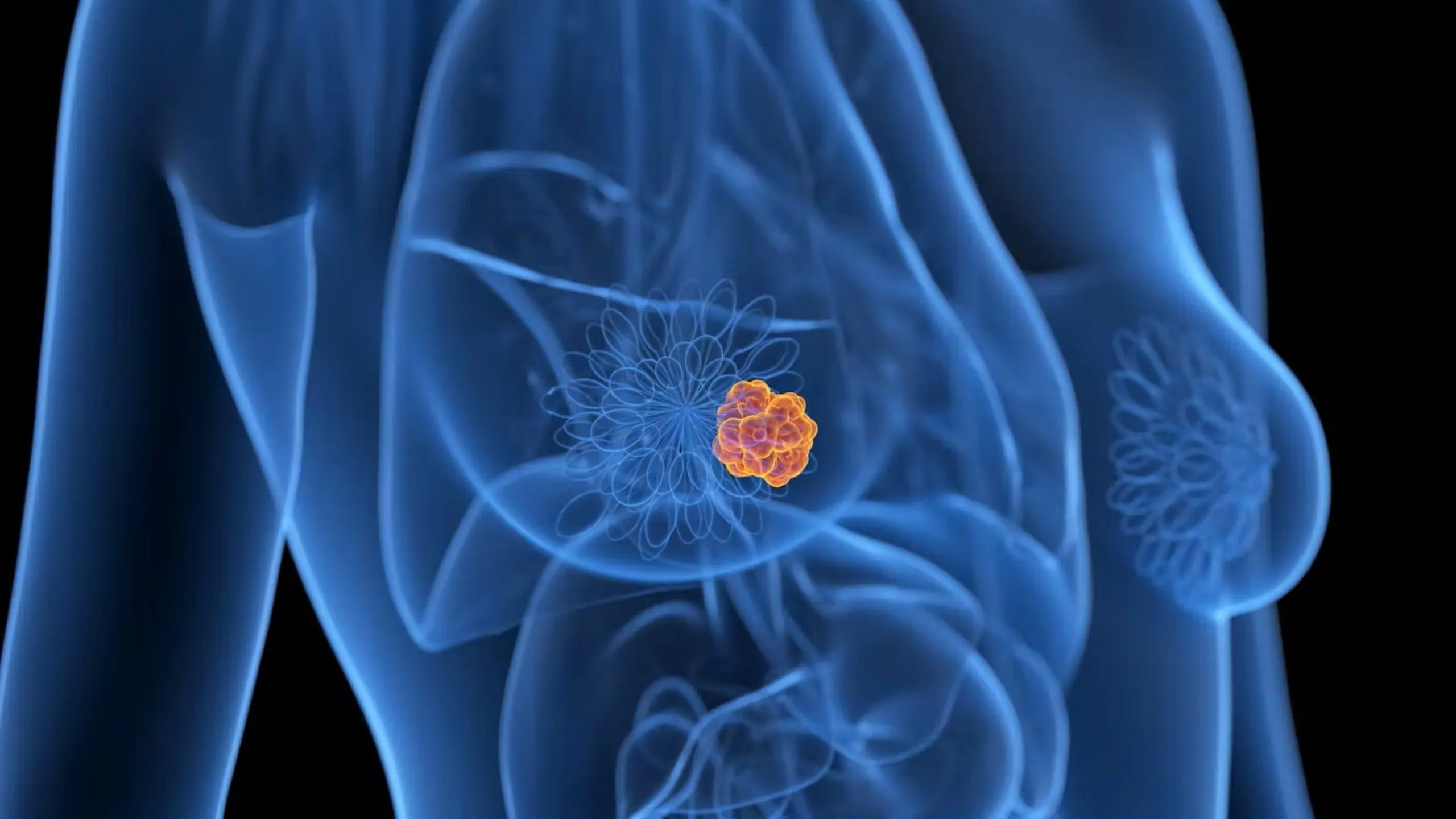 Cáncer de mama analizado mediante inteligencia artificial para predecir tratamientos