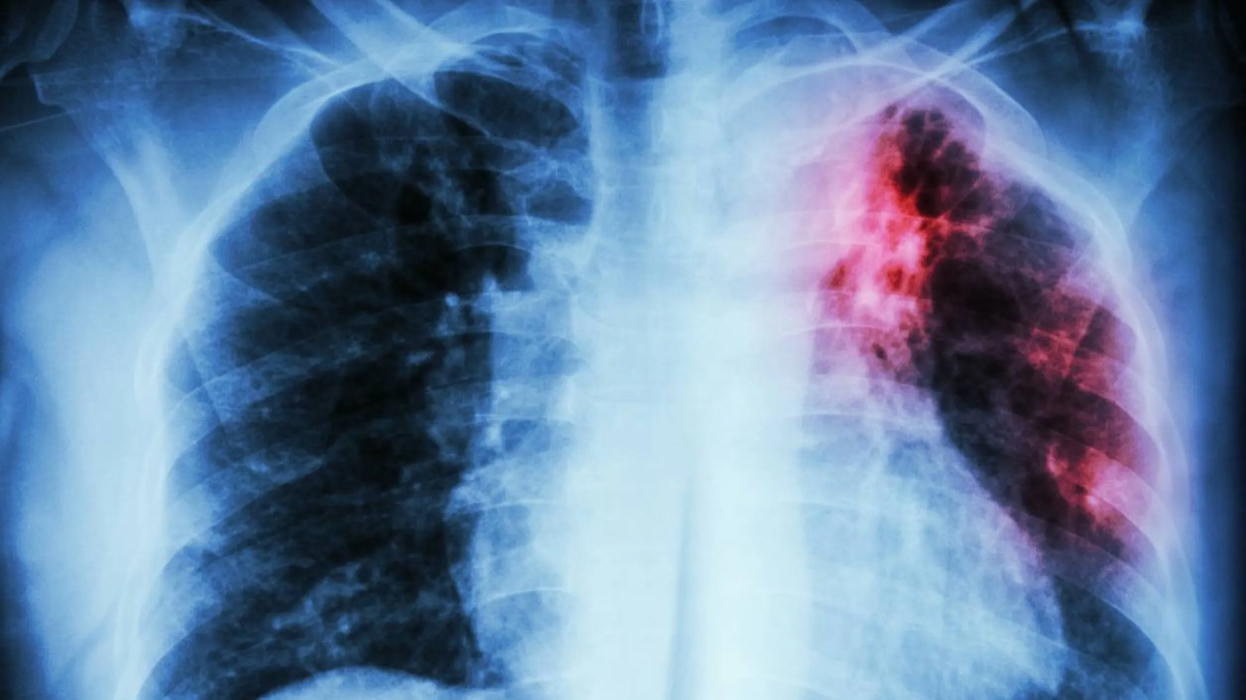 Tuberculosis y los desafíos científicos para mejorar vacunas y tratamientos contra la enfermedad